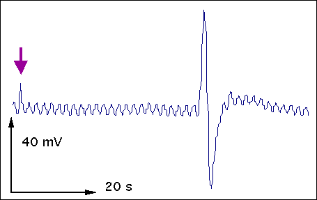 stimulation effectu&eacute;e sur une foliole terminale